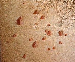 皮肤上的人乳头瘤病毒