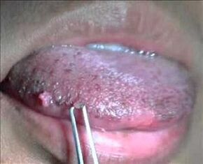 舌头上的人乳头瘤病毒