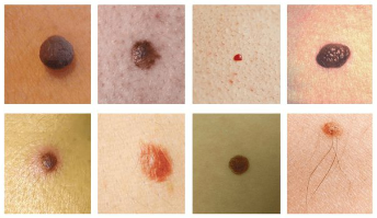 最常见的皮肤上的斑点是痣和乳头瘤(疣)